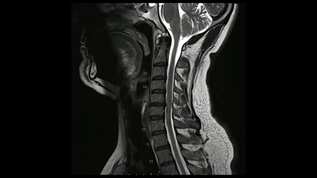 rettilineizzazione del rachide cervicale