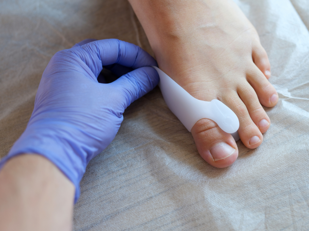 alluce valgo fisioterapia