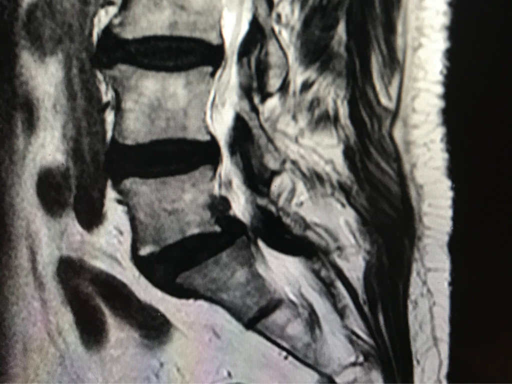 spondilolistesi milano fisioterapista