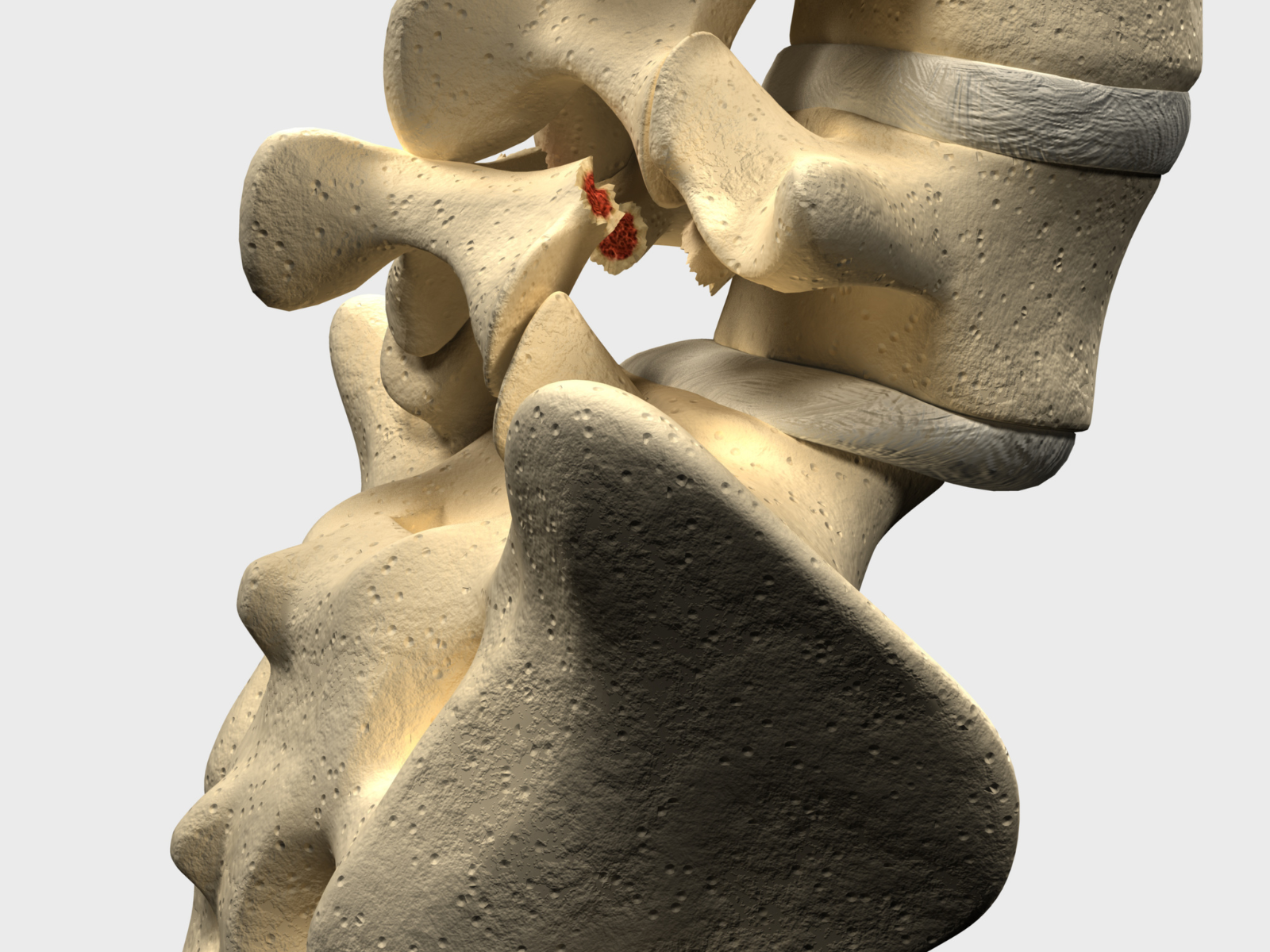 spondilolistesi spondilolistesi
